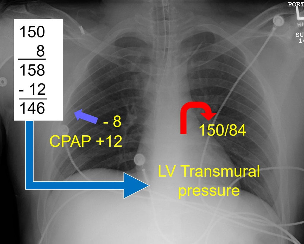 The Miracle of CPAP EMS Airway