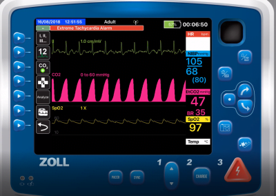 Using Capnography to Titrate CPAP