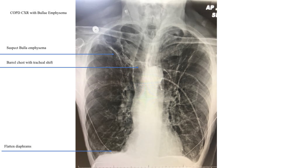 Emphysema Chest X Ray