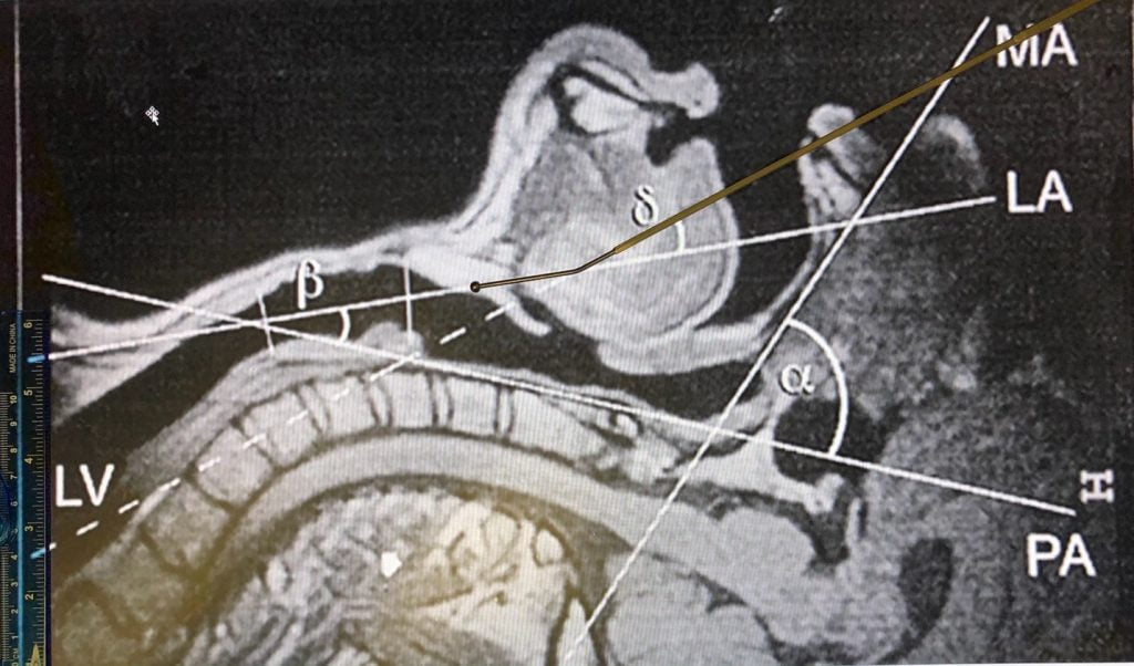 Fig. 2. AIROD® aligned perfectly with the line of vision (LV) with the head in simple extension. Transition to the laryngeal axis (LA) is easy due to the specialized 20-degree tip.