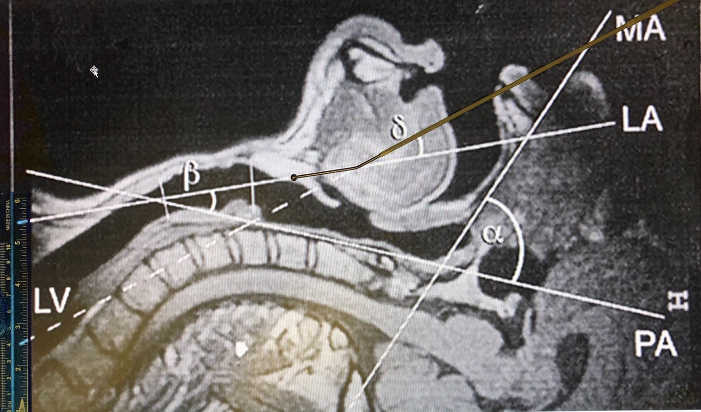 The Importance of Head Positioning During Endotracheal Intubation - EMS ...