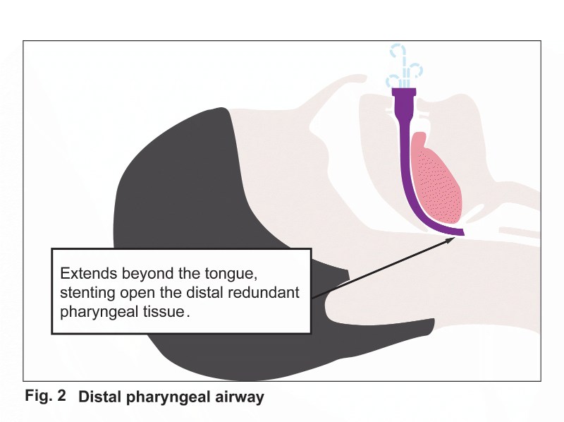 Distal pharyngeal airway
