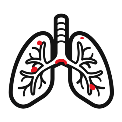 A drawing of a pulmonary embolism.