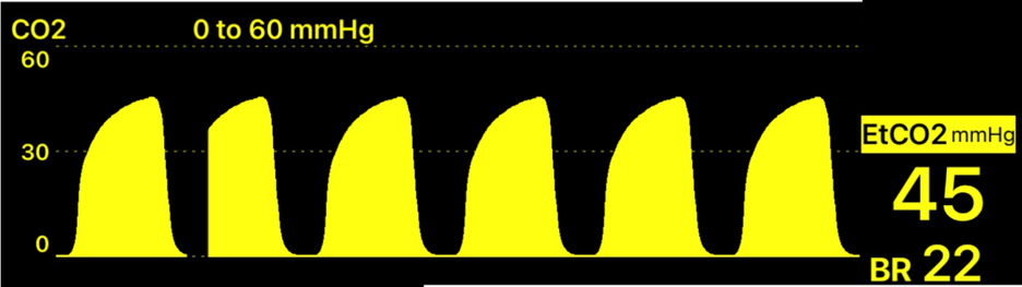 Friday Night Lights: Shift 20—The Silent Retainer - EMS Airway